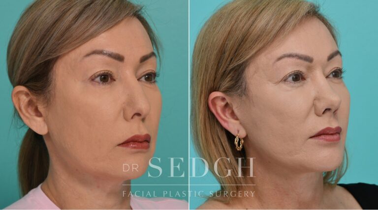 Patient before and after Revision Rhinoplasty, Facelift, and Chin Augmentation | Sedgh