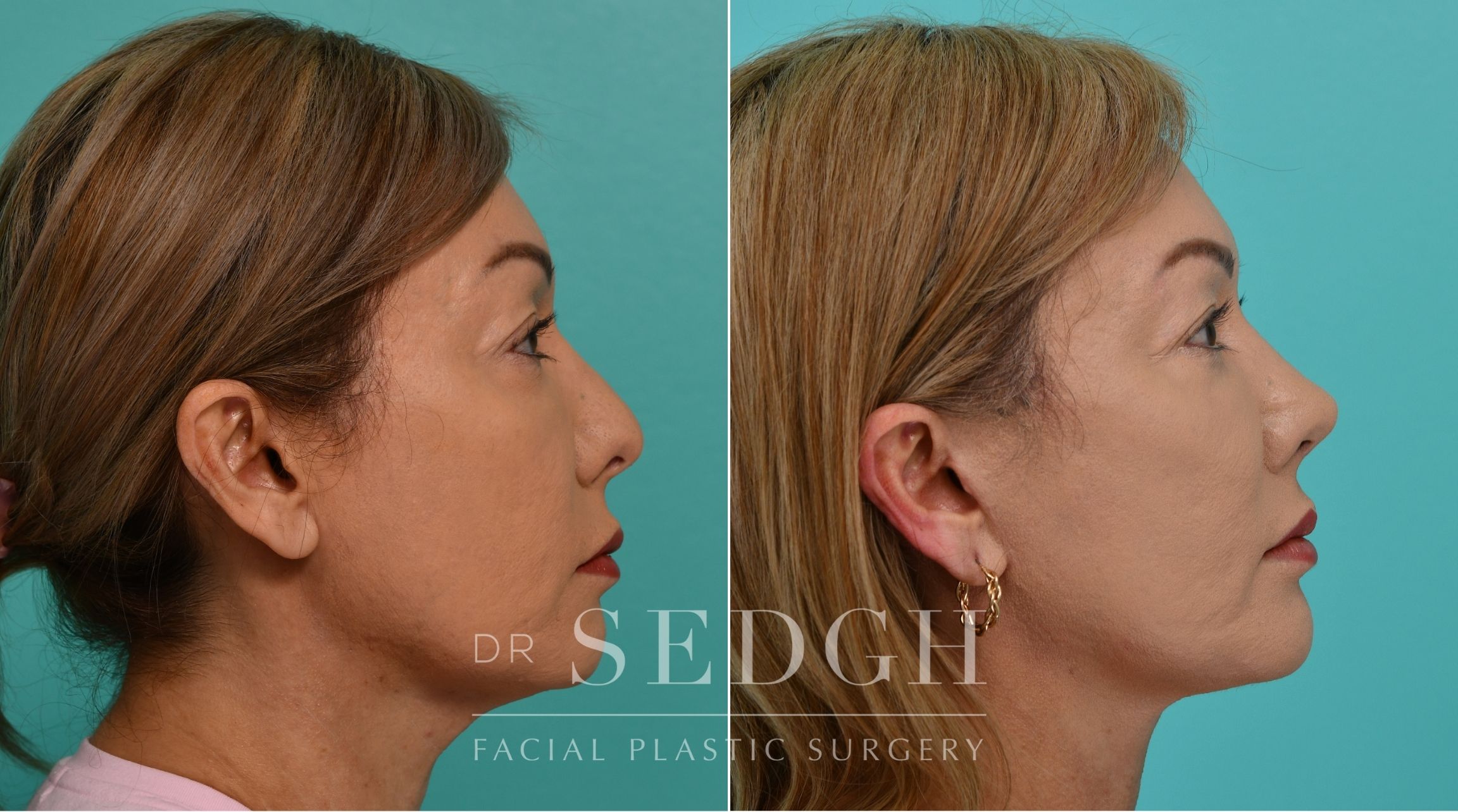 Patient before and after Revision Rhinoplasty, Facelift, and Chin Augmentation | Sedgh