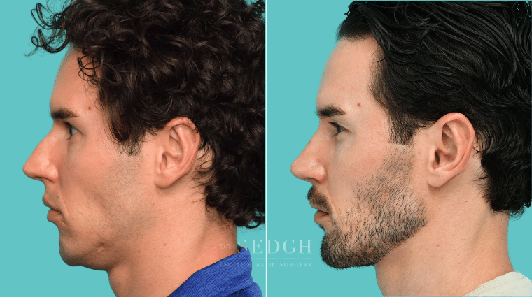 375 Male Rhinoplasty Revision Chin Augmentation