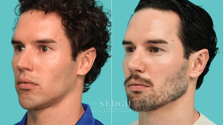 375 Male Rhinoplasty Revision Chin Augmentation