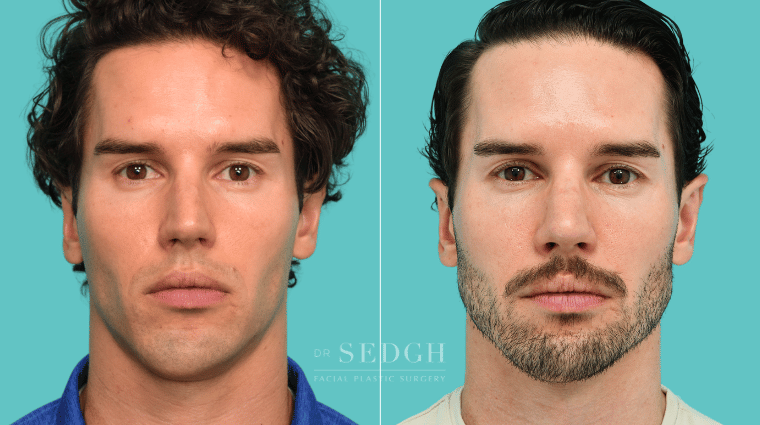 375 Male Rhinoplasty Revision Chin Augmentation