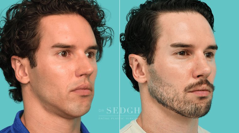375 Male Rhinoplasty Revision Chin Augmentation
