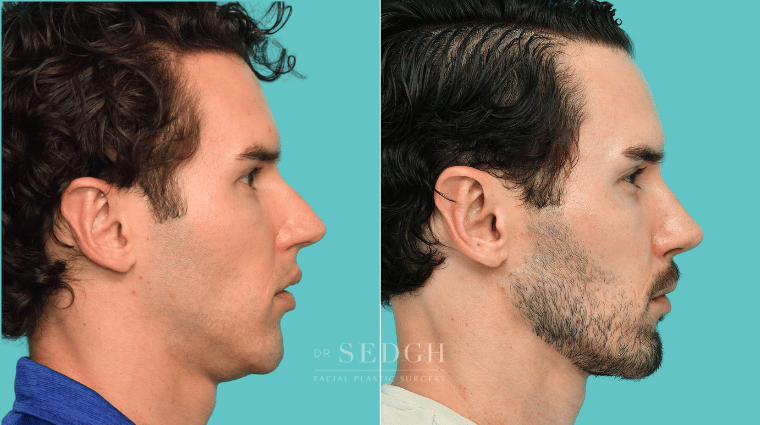 375 Male Rhinoplasty Revision Chin Augmentation