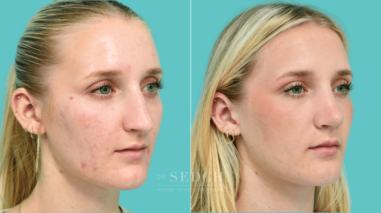 376 Female Rhinoplasty Before & After