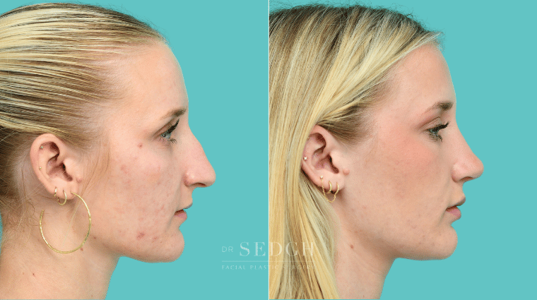 376 Female Rhinoplasty Before & After