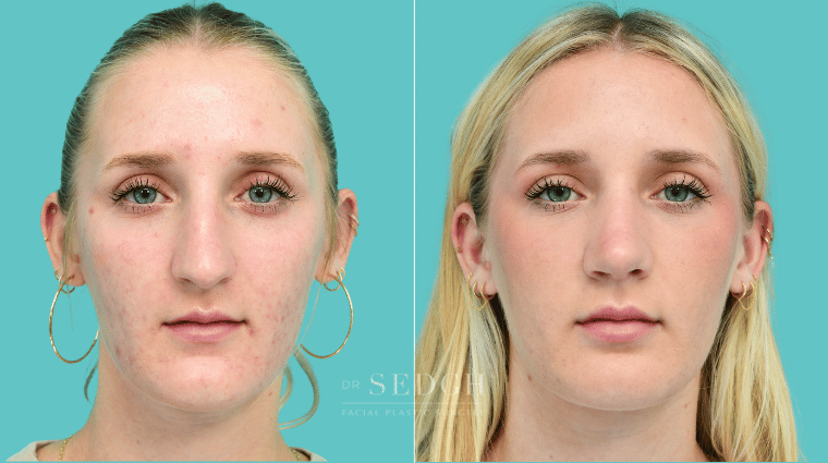 376 Female Rhinoplasty Before & After