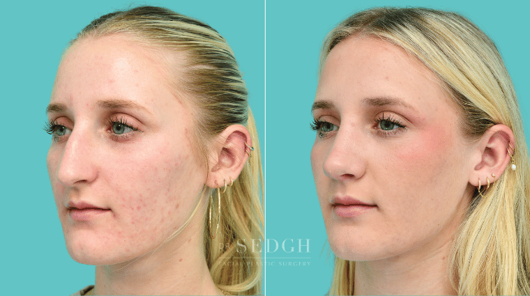 376 Female Rhinoplasty Before & After