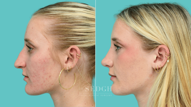 376 Female Rhinoplasty Before & After