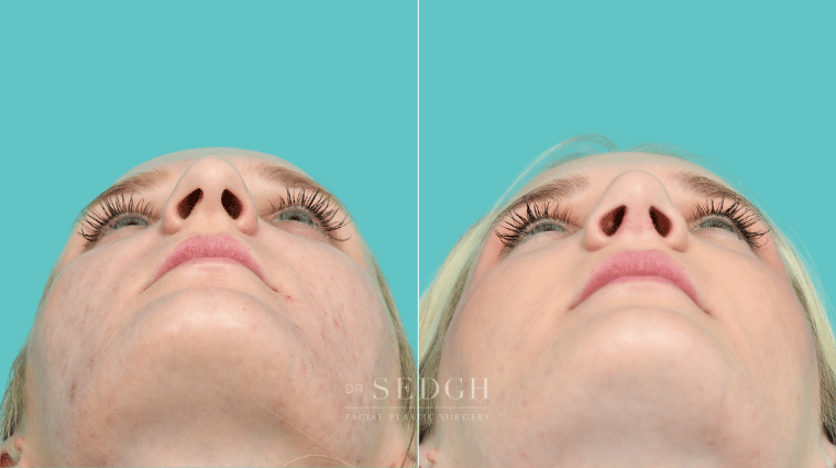 376 Female Rhinoplasty Before & After