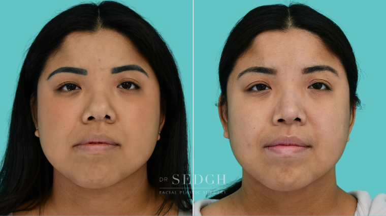 377 Asian Female Rhinoplasty Before & After