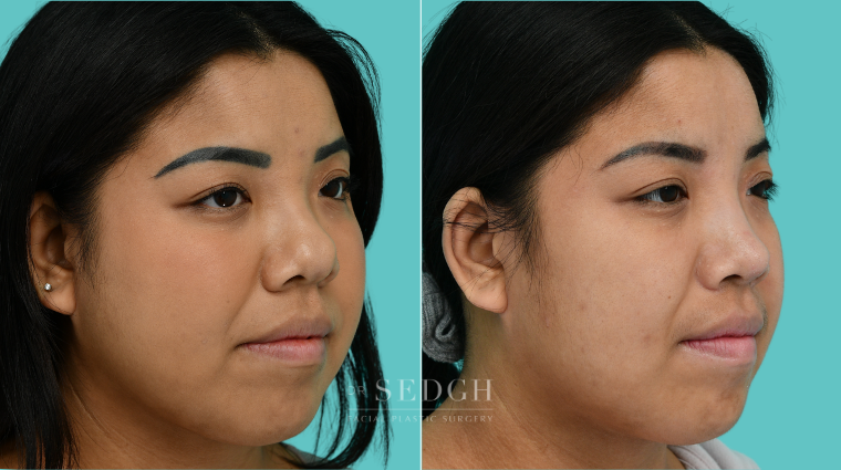 377 Asian Female Rhinoplasty Before & After