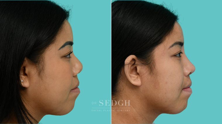 377 Asian Female Rhinoplasty Before & After Transformation