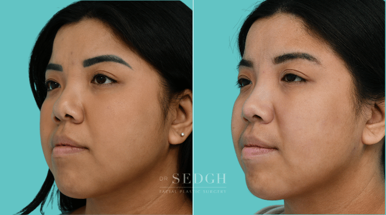 377 Asian Female Rhinoplasty Before & After