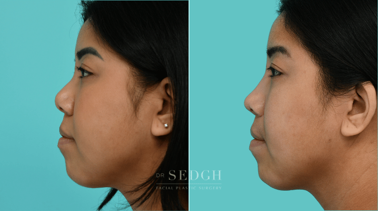 377 Asian Female Rhinoplasty Before & After