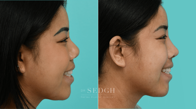 377 Asian Female Rhinoplasty