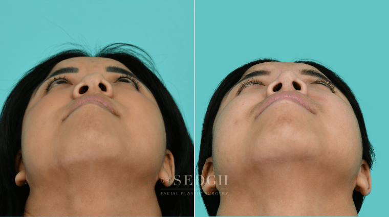 377 Asian Female Rhinoplasty Before & After
