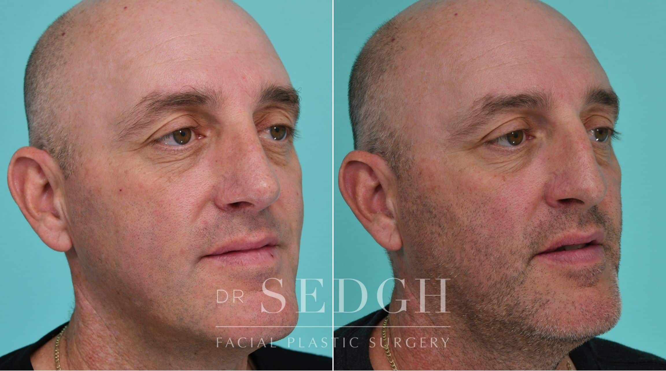 Patient before and after Rhinoplasty | Sedgh