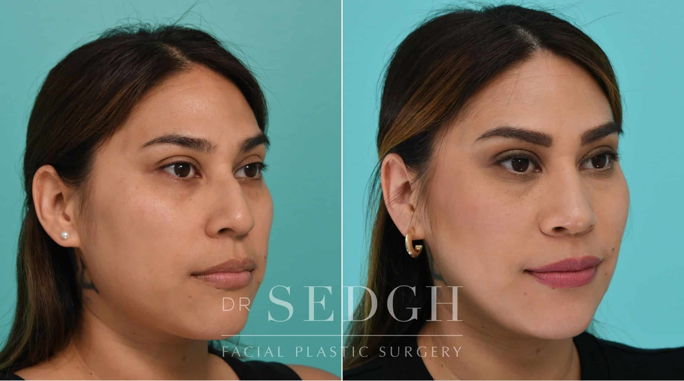 Patient before and after Rhinoplasty | Sedgh