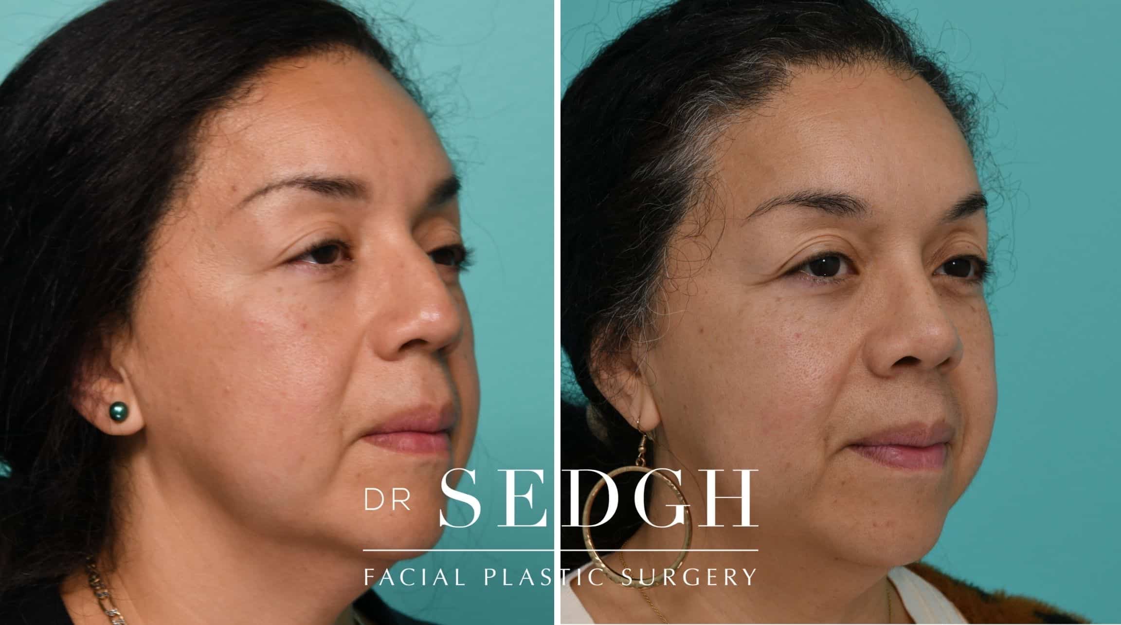 Patient before and after Revision Rhinoplasty | Sedgh