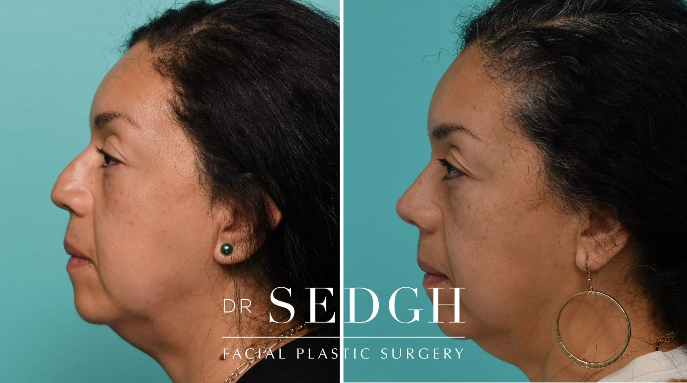 Patient before and after Revision Rhinoplasty | Sedgh
