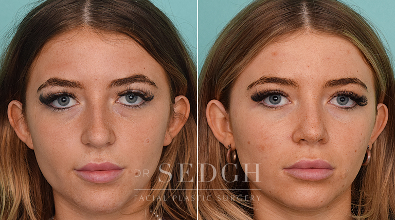 female patient before and after rhinoplasty procedure