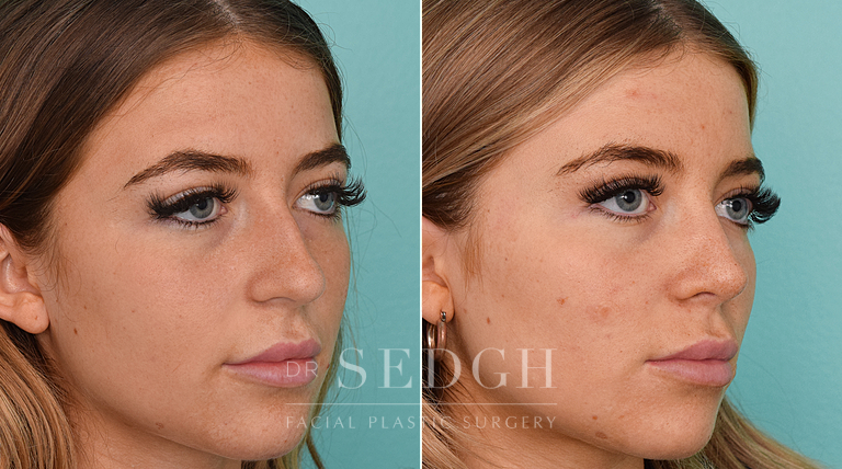 female patient before and after rhinoplasty procedure