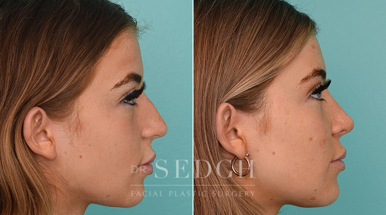 female patient before and after rhinoplasty procedure