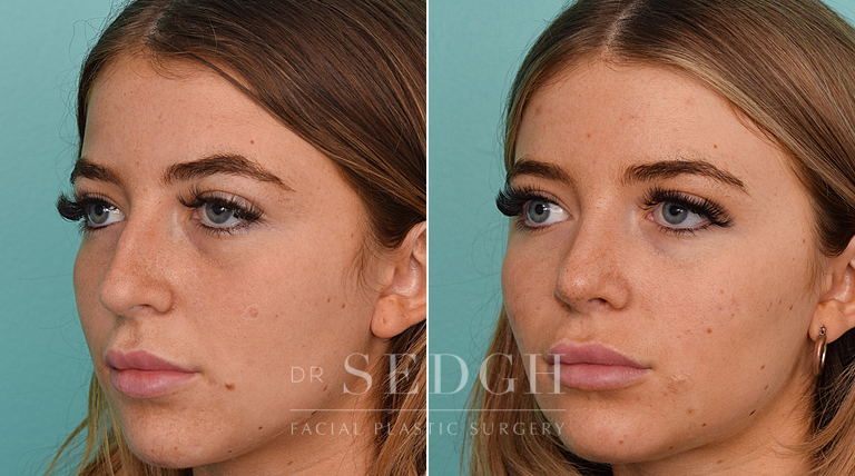 female patient before and after rhinoplasty procedure