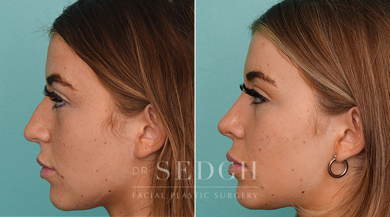 female patient before and after rhinoplasty procedure