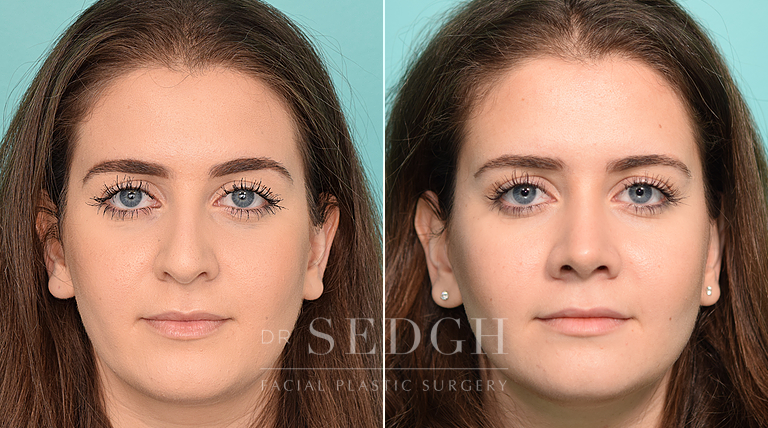 female patient before and after rhinoplasty procedure