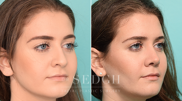 female patient before and after rhinoplasty procedure