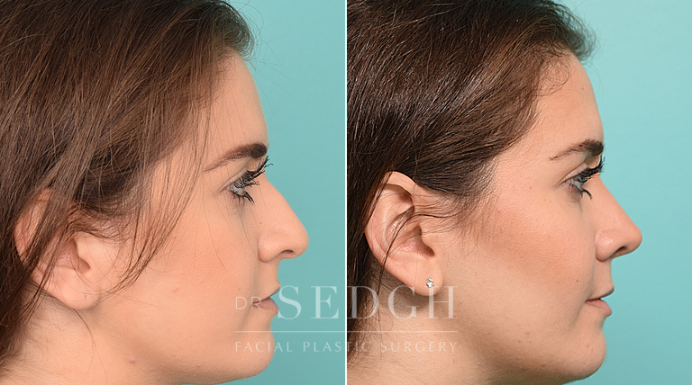 female patient before and after rhinoplasty procedure