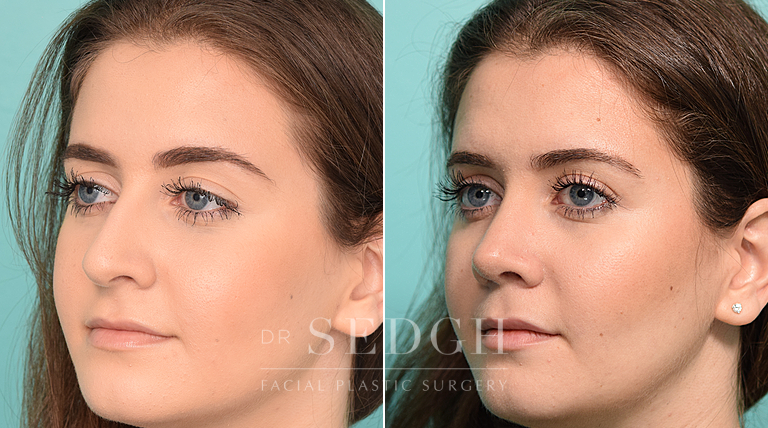 female patient before and after rhinoplasty procedure