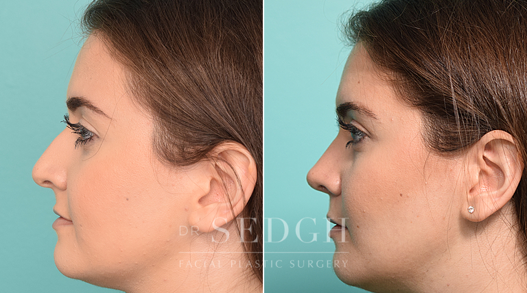 female patient before and after rhinoplasty procedure