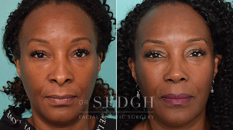 female patient before and after rhinoplasty procedure