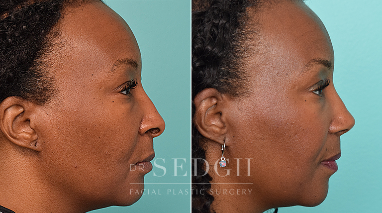 female patient before and after rhinoplasty procedure