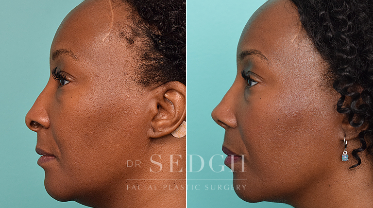 female patient before and after rhinoplasty procedure