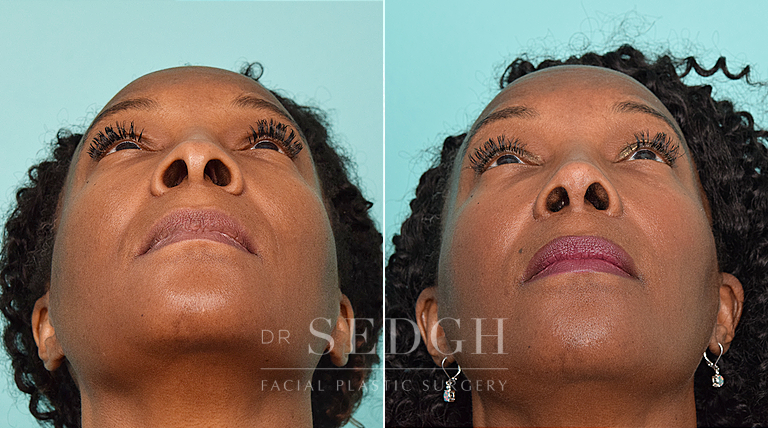 female patient before and after rhinoplasty procedure