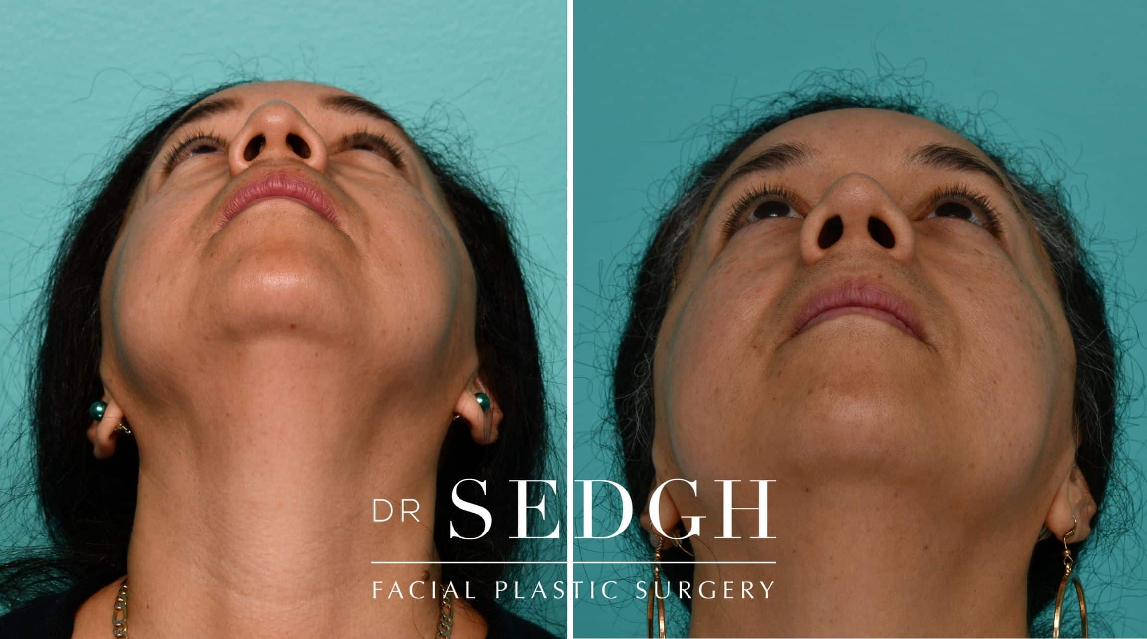 Patient before and after Revision Rhinoplasty | Sedgh