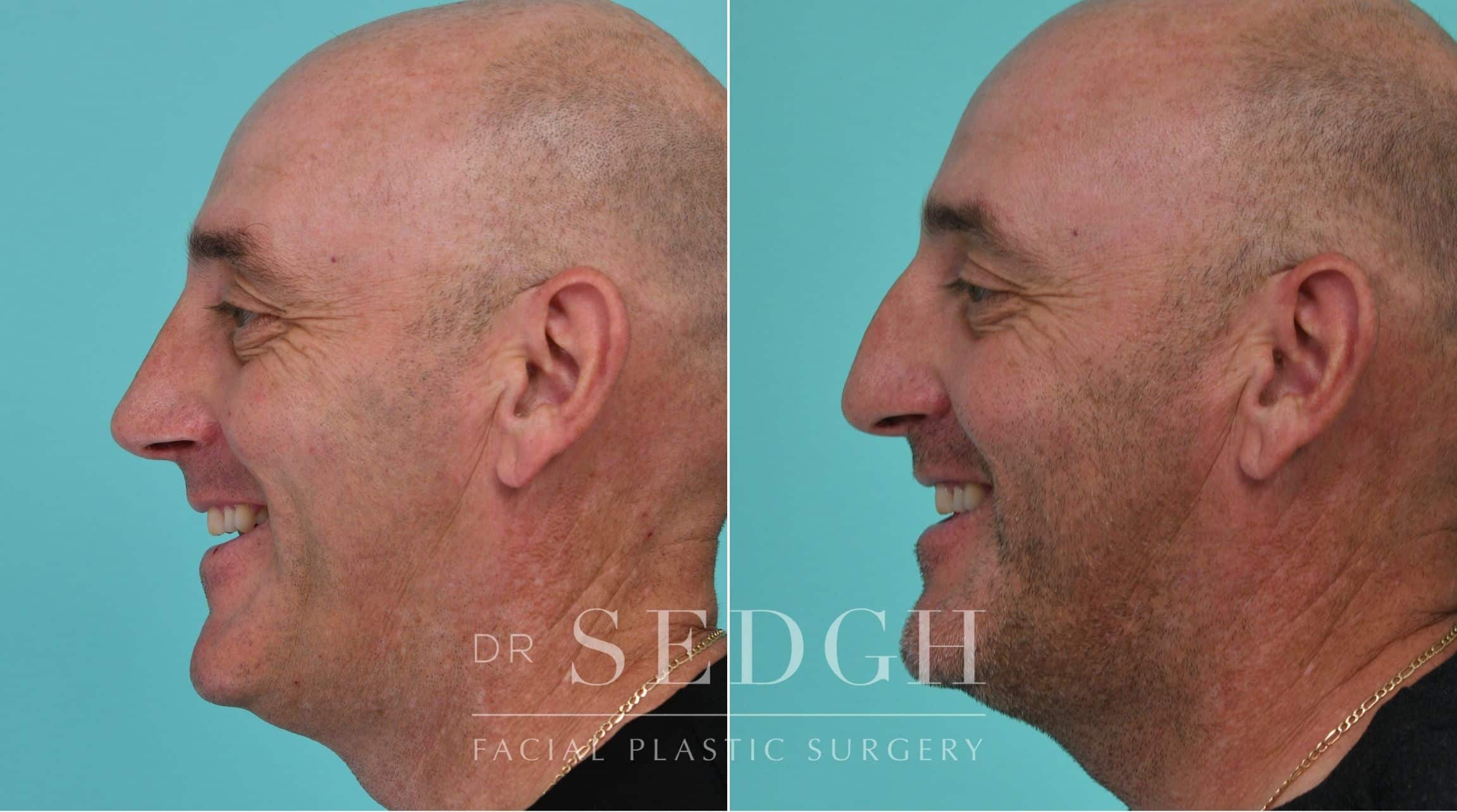 Patient before and after Rhinoplasty | Sedgh