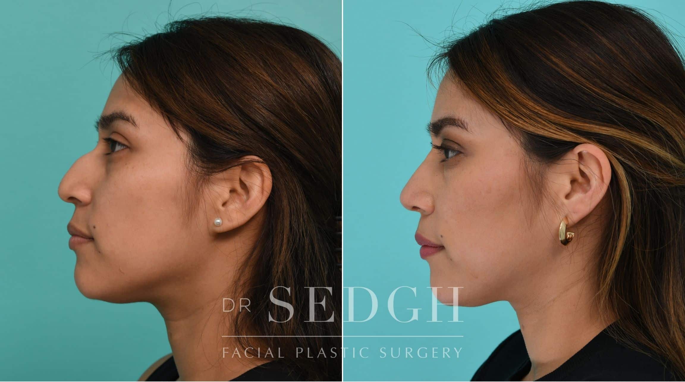 Patient before and after Rhinoplasty | Sedgh