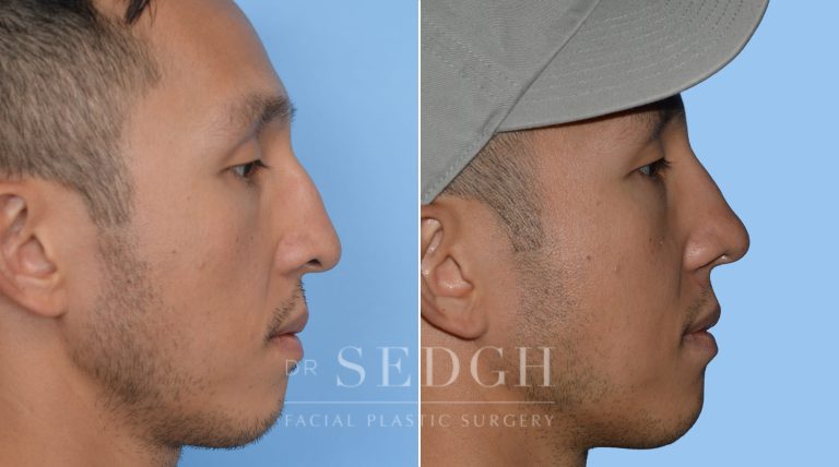 Male Rhinoplasty Before and After | Sedgh