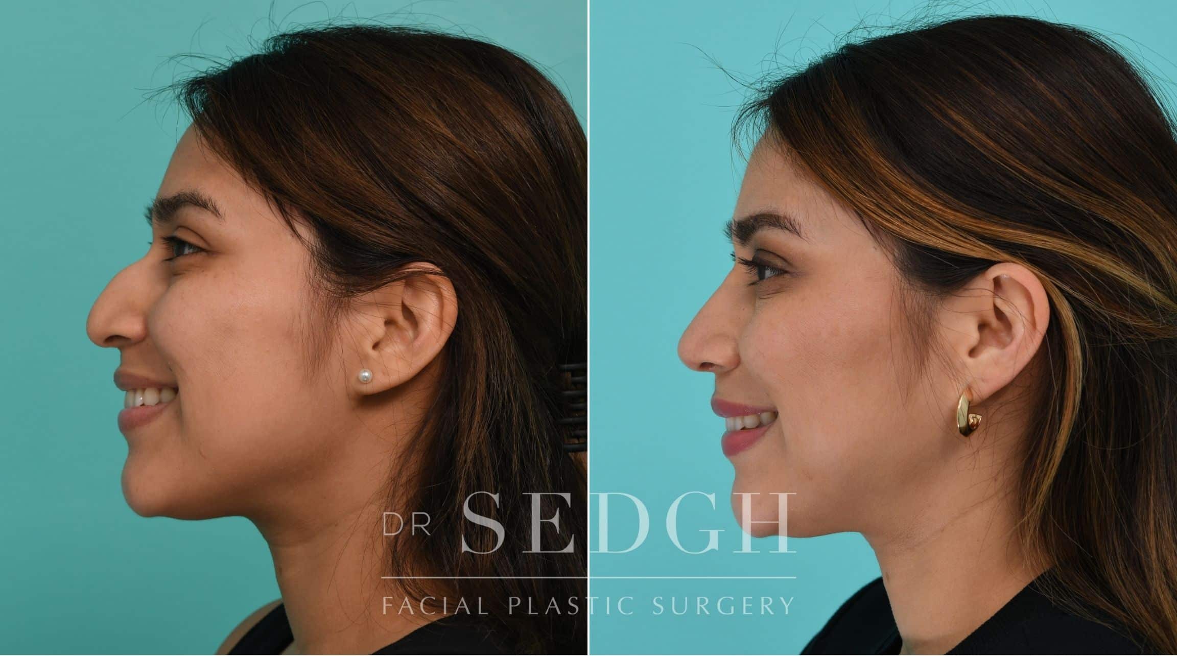 Patient before and after Rhinoplasty | Sedgh