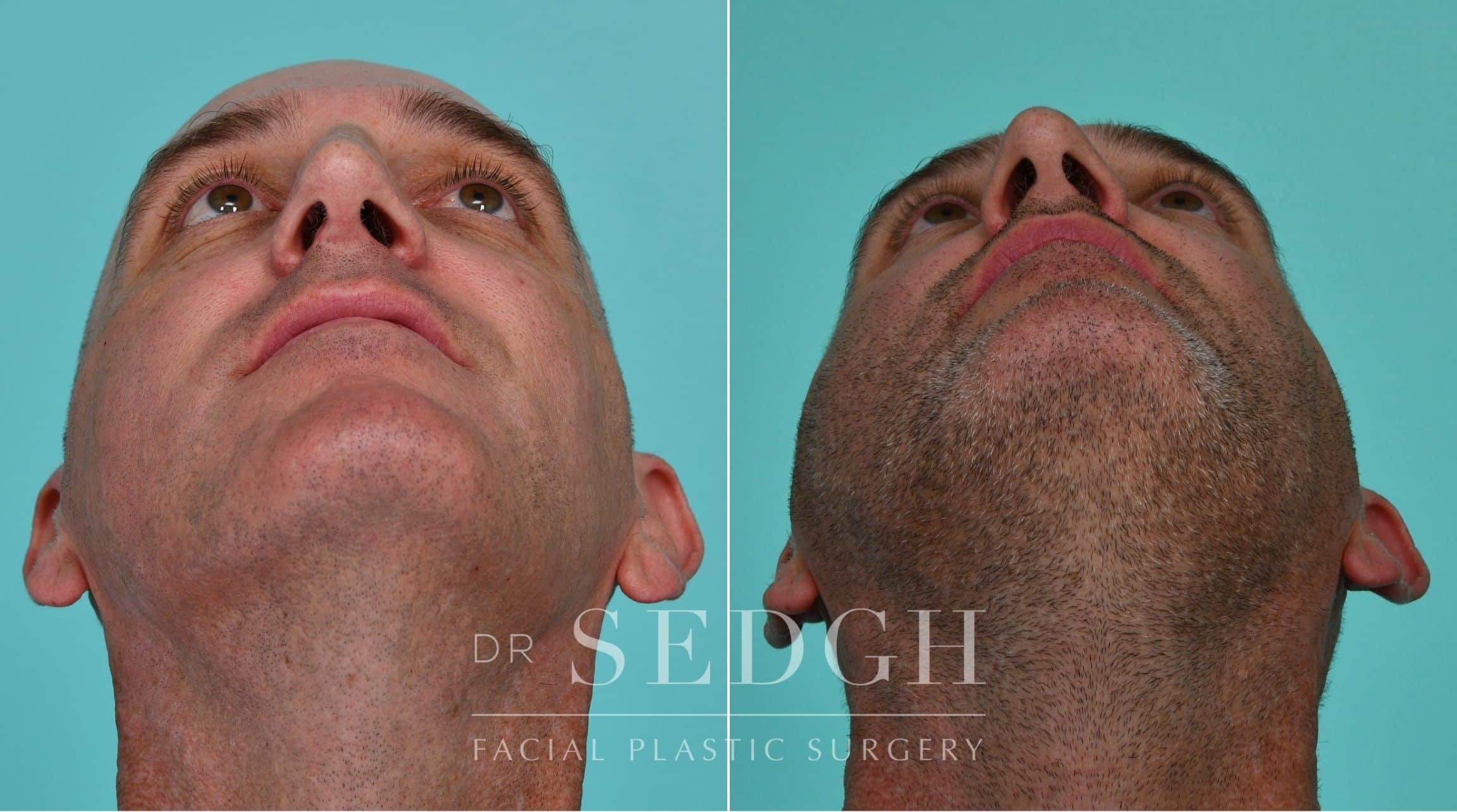 Patient before and after Rhinoplasty | Sedgh