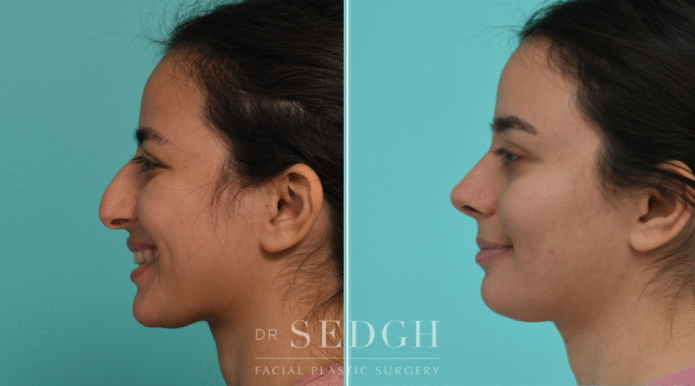 Left side rhinoplasty surgery before and after