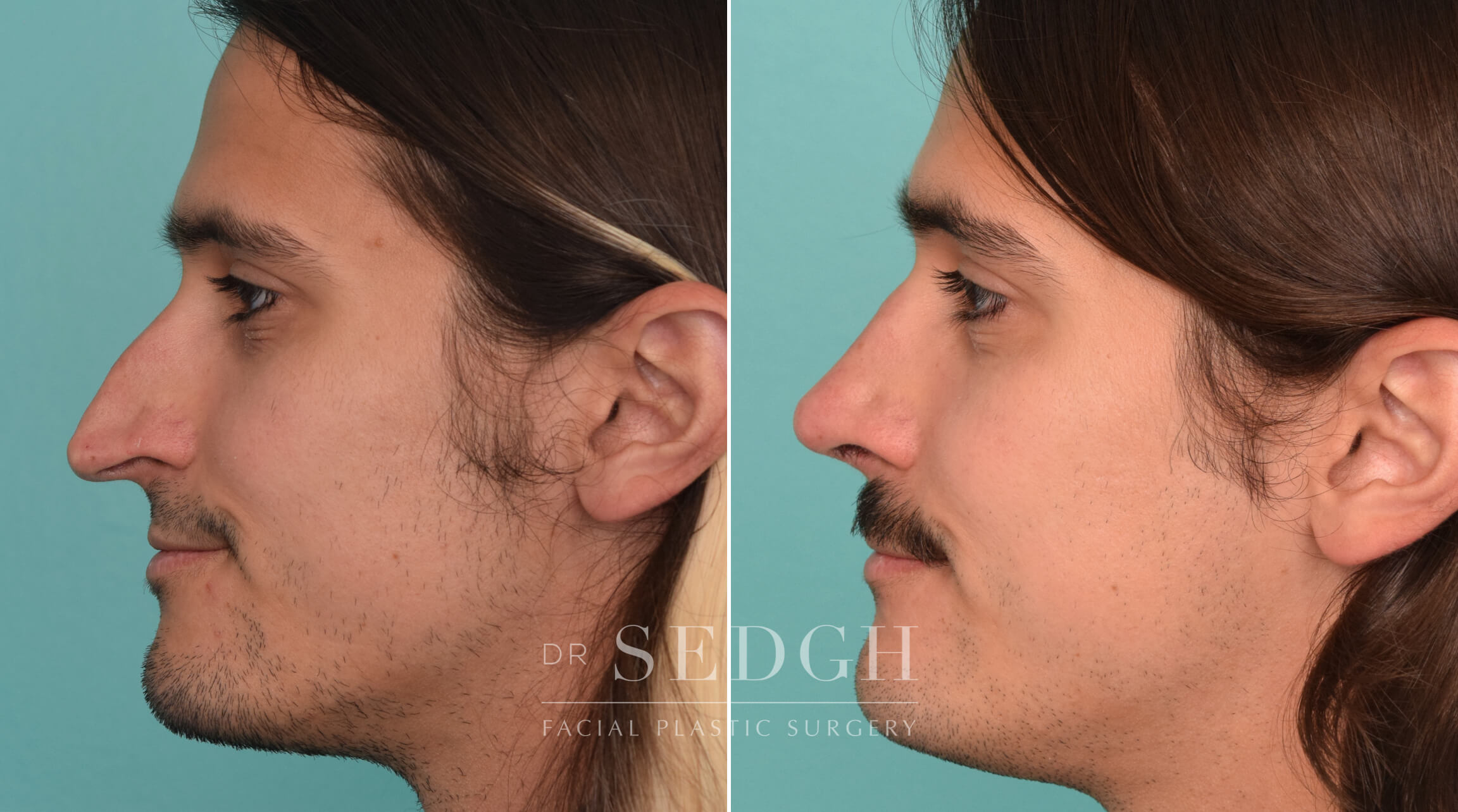 Hispanic Rhinoplasty Before & After Photos | Dr. Sedgh