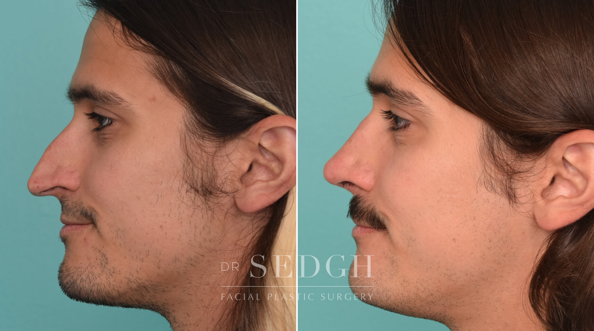 🥇 Hispanic Rhinoplasty Before & After Photos | Dr. Sedgh