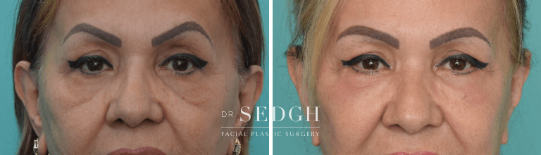 Lower Blepharoplasty Before and After