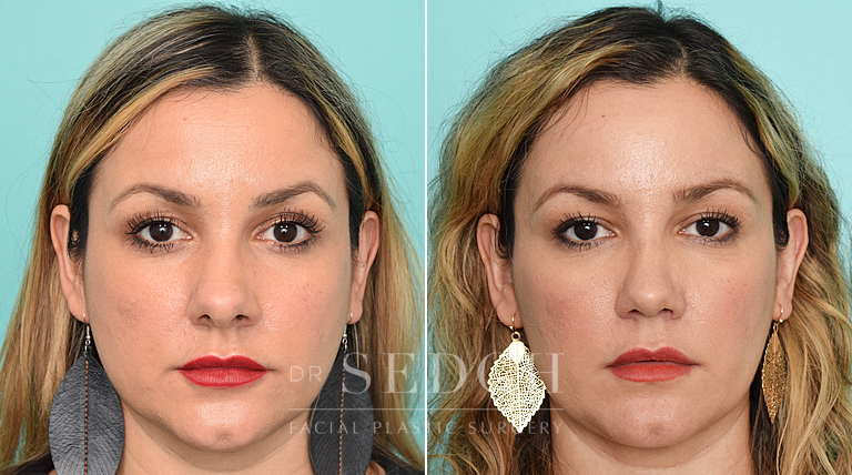 patient before and after rhinoplasty procedure