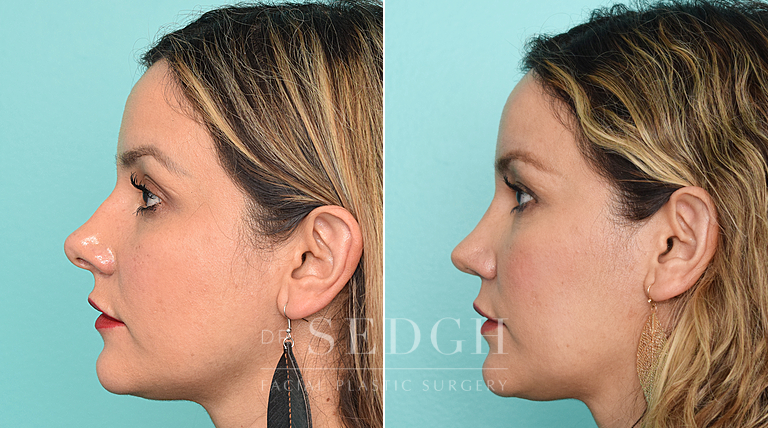 patient before and after rhinoplasty procedure